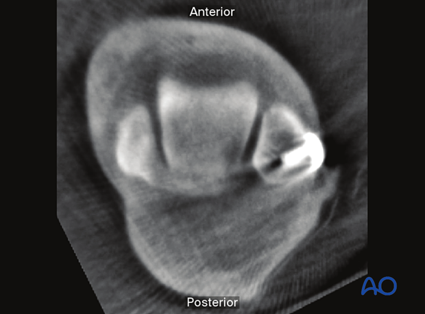 Axial plane (5 mm distal to the talar joint line)