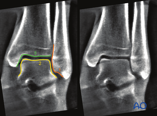 Intraoperative imaging of the ankle