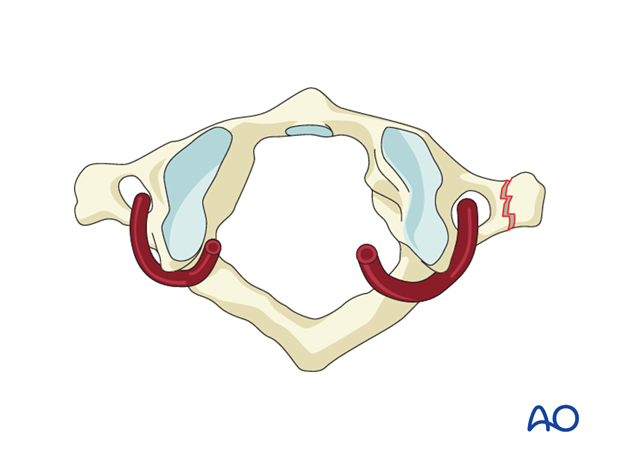 Transverse process injury