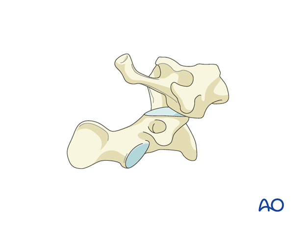 C1–C2 dislocations