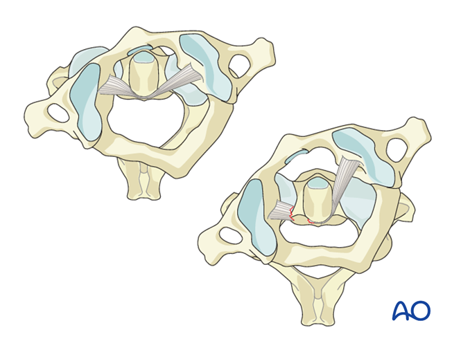 AO Spine upper cervical injuries classification system