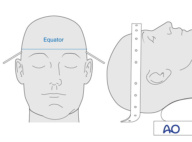 temporary halo and traction