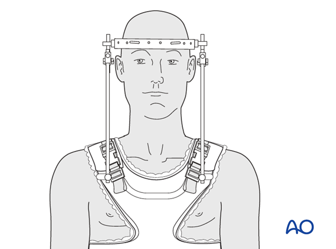 Halo vest for Region I Type B: Nondisplaced ligamentous injury ...