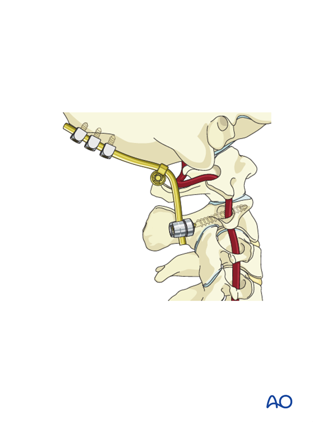 posterior c1 c2 fusion