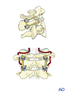 Posterior C1-C2 fusion