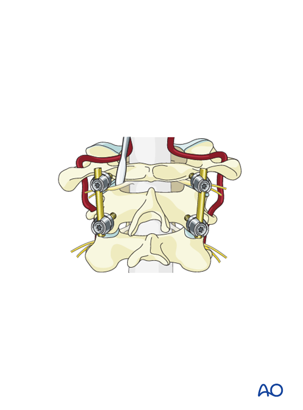 The C2 nerve is reflected caudally.