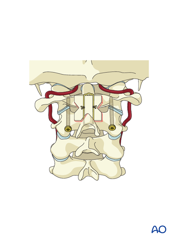 posterior c1 c2 fixation