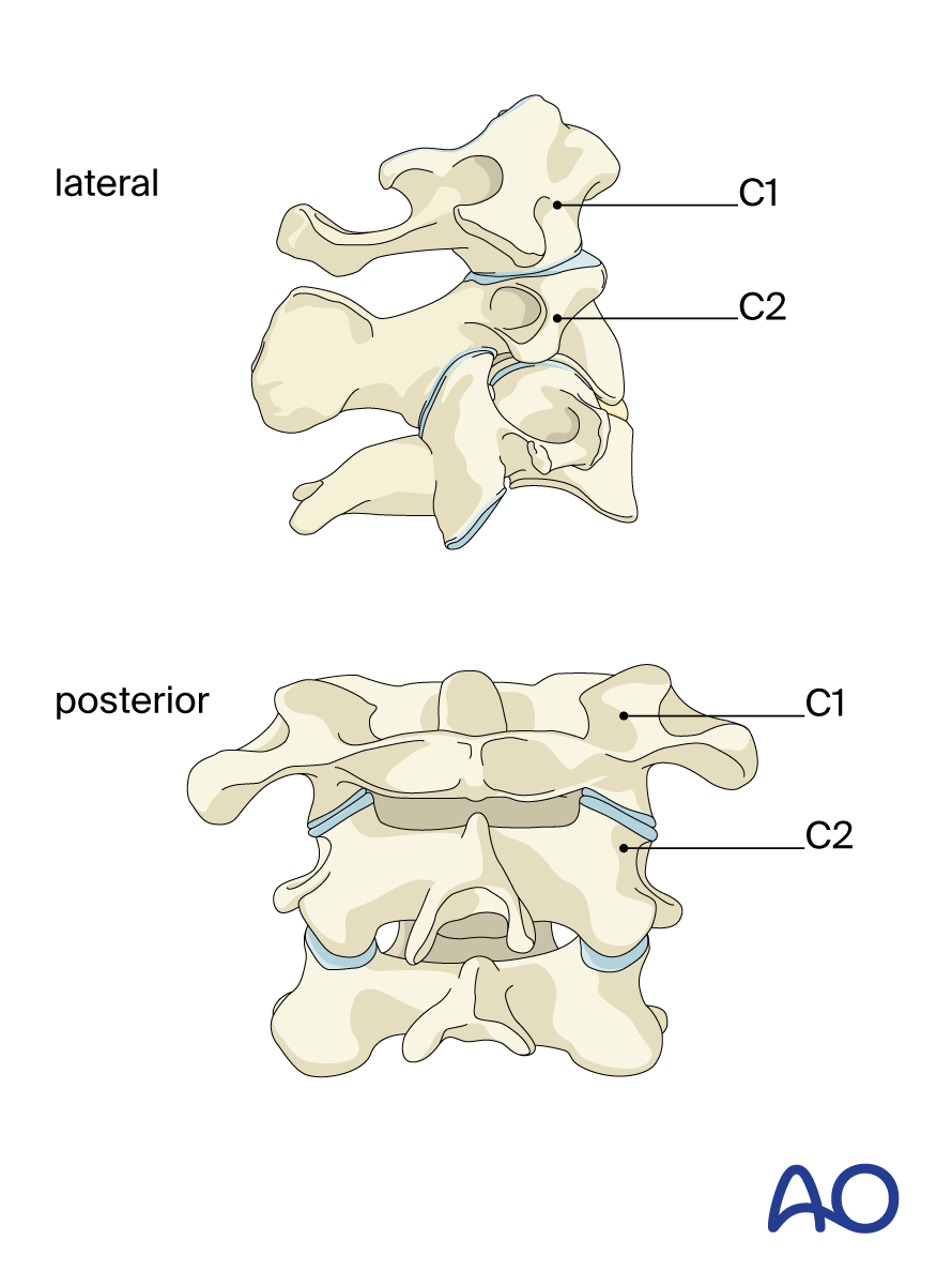 Posterior C1–C2 fusion for Region II Type C: Translation injury of the  C1–C2 joint