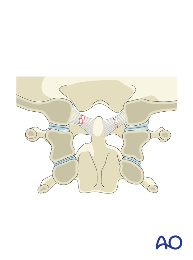 Atlanto-occipital ligament injury (Type B)