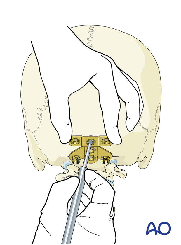 The location of the central cranial screw entry point is marked with the plate in place