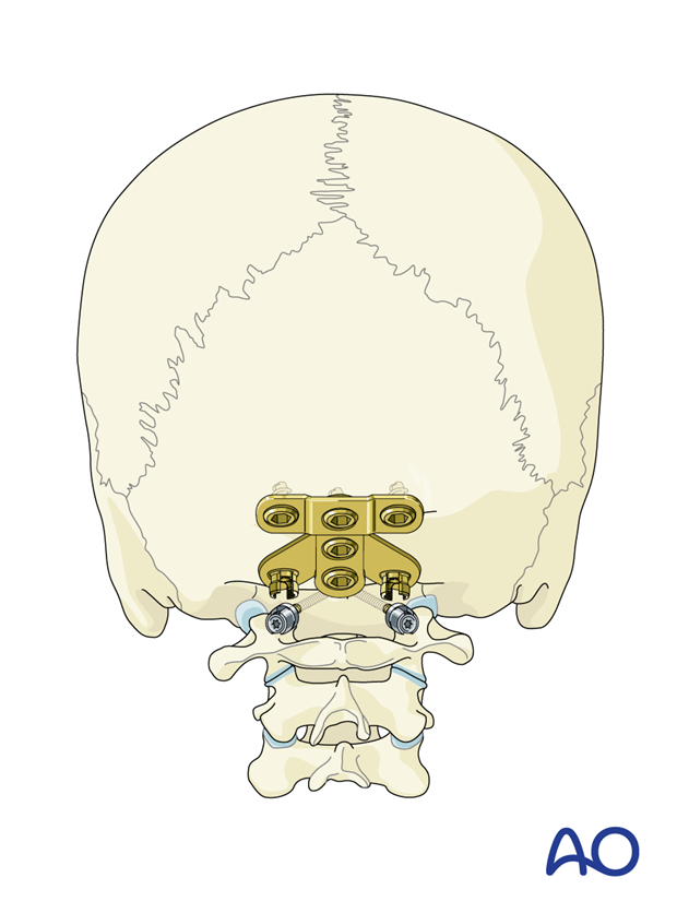 occipitocervical fusion screw fixation