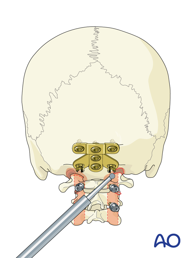 occipitocervical fusion screw fixation