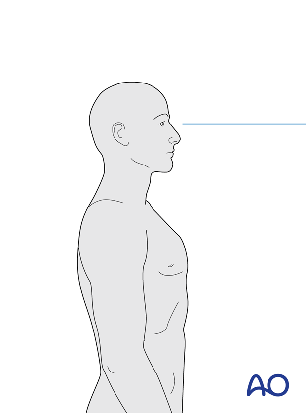 Align the head to allow for a horizontal gaze once the fusion is complete.