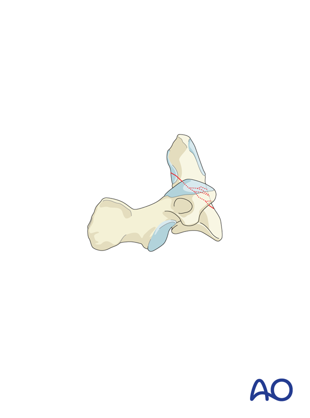 Anterior odontoid screw fixation is contraindicated for fractures running from anterior caudal to posterior cranial. 