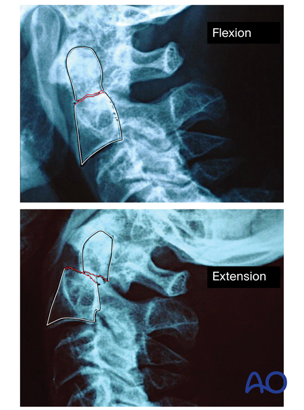 X-rays showing a flexion fracture, with an anterior displacement of the dens and an extension fracture, with a posterior displacement of the dens.