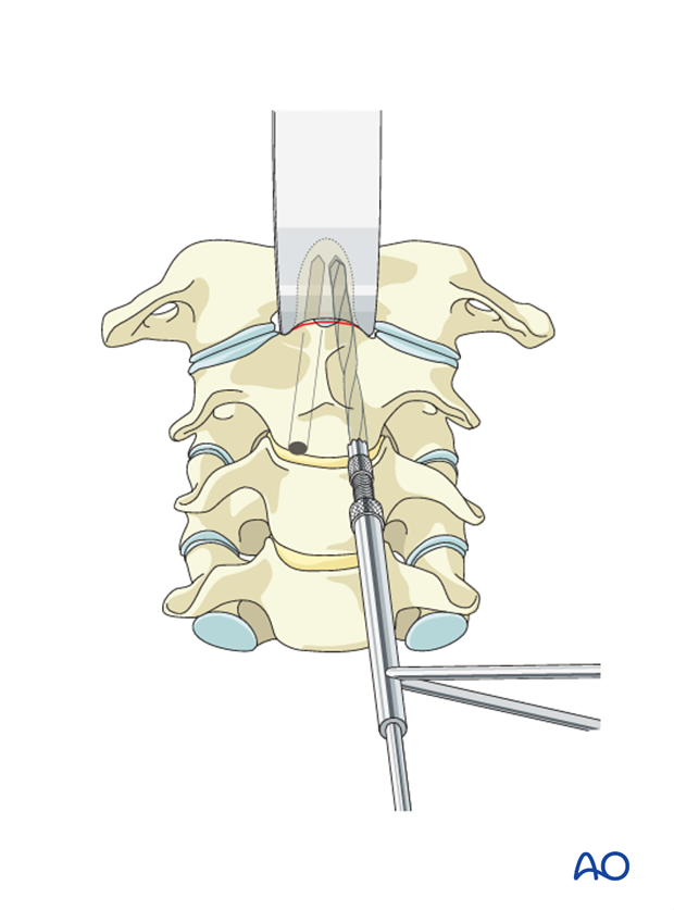 odontoid screw fixation