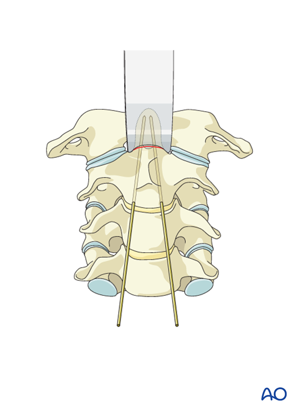 odontoid screw fixation