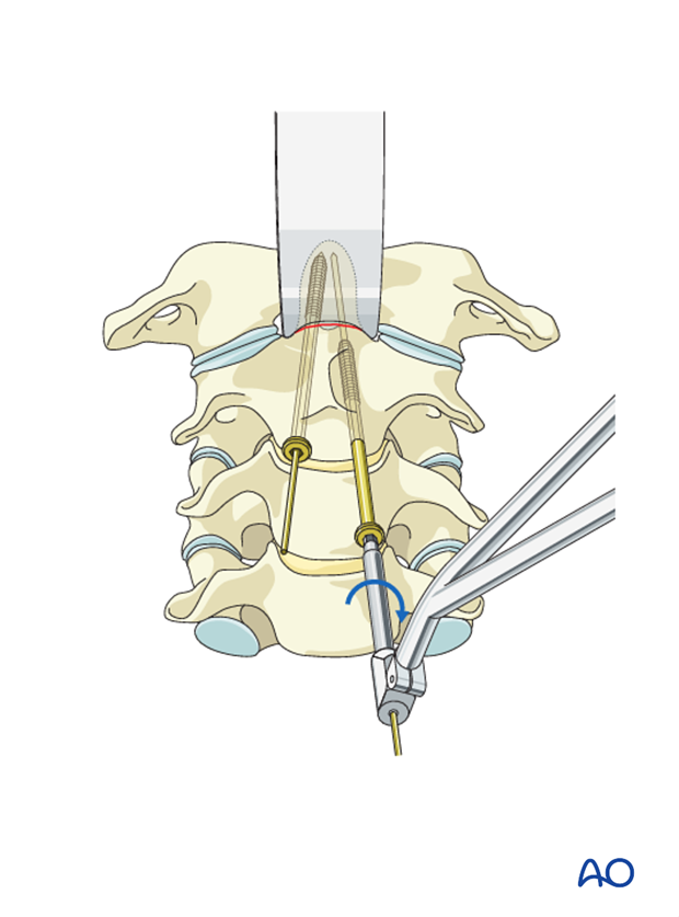 odontoid screw fixation