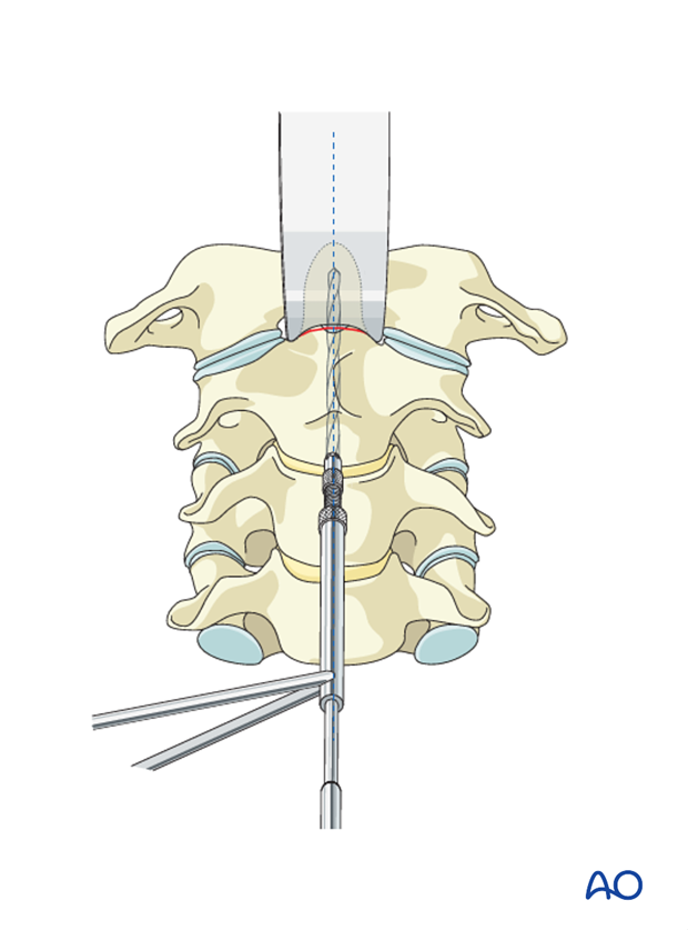 odontoid screw fixation