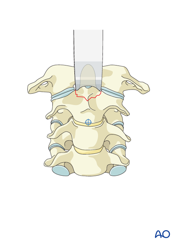odontoid screw fixation