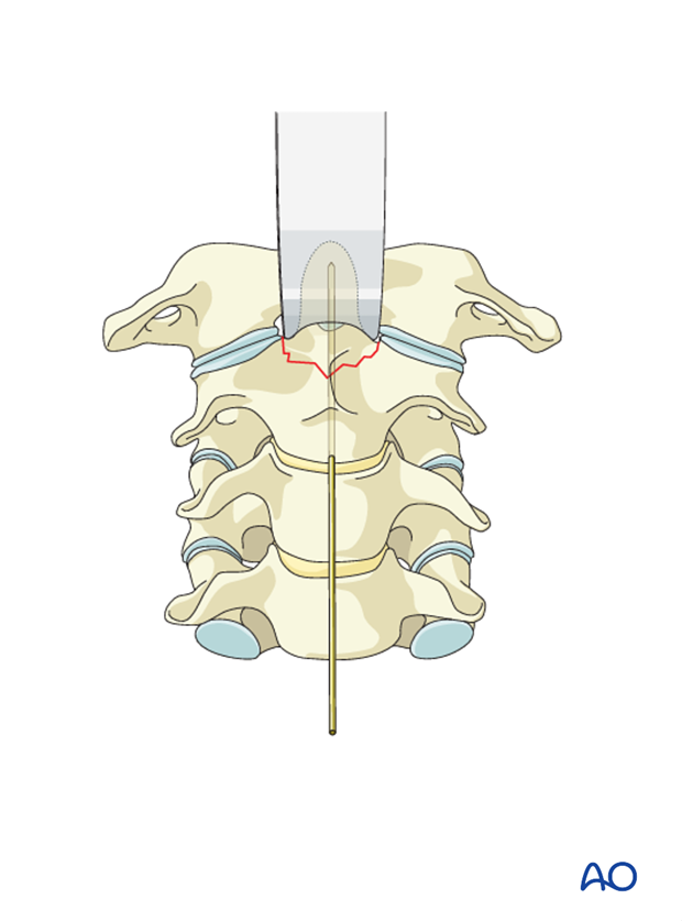 odontoid screw fixation