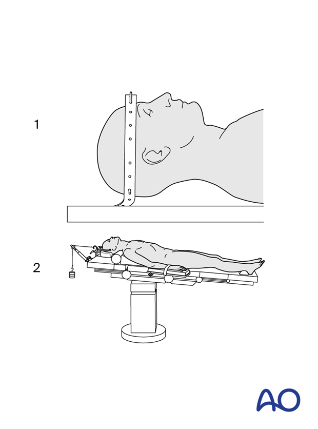 Reduction performed using halo traction preoperatively (1) and a Mayfield clamp intraoperatively (2).