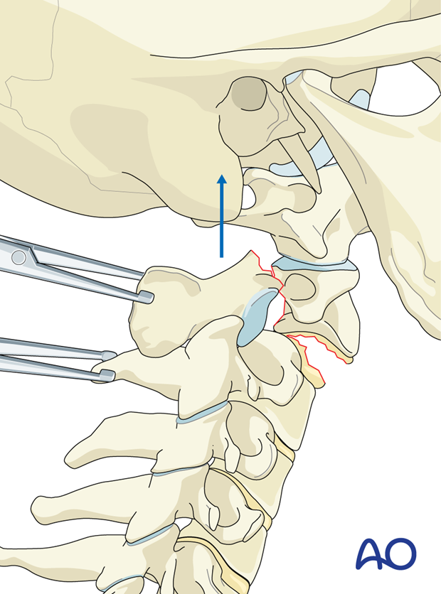 A bilateral facet dislocation can be unlocked with gentle manual distraction applied across clamps placed on the spinous processes of C2 and C3.