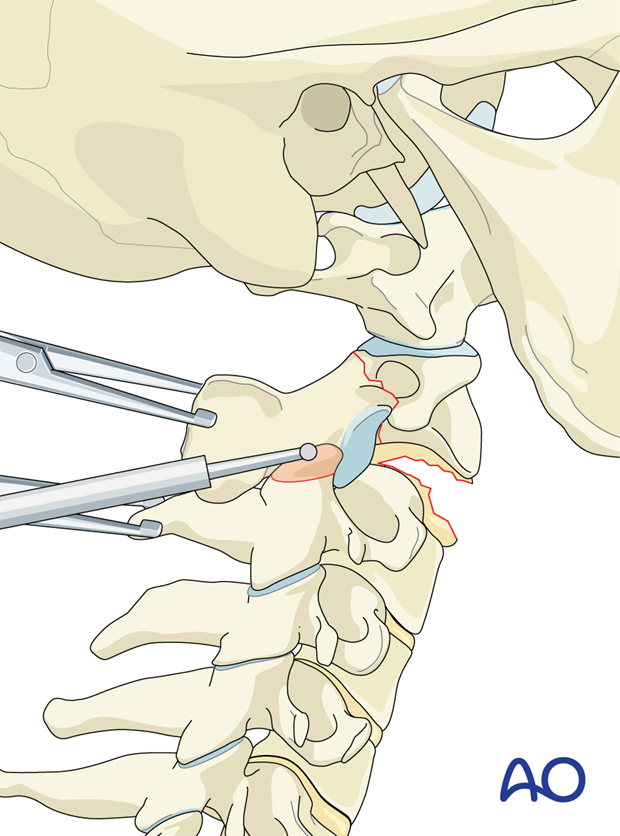 A partial facetectomy, in the form of resection of the superior-most projection of the superior facet of the level below the dislocation, may facilitate facet reduction.