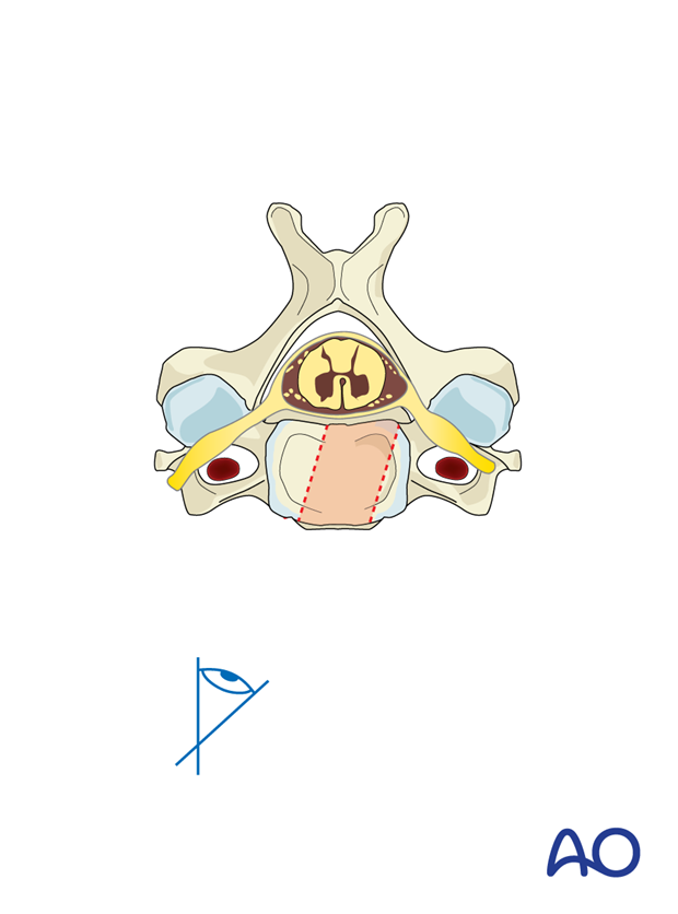 During anterior fixation there may be a tendency to direct the decompression to the contralateral side, as shown here.