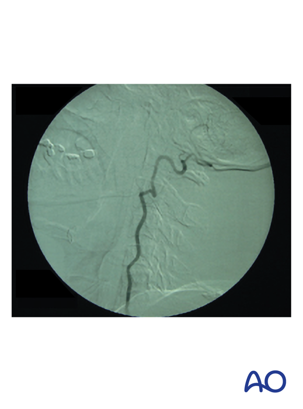 A preoperative angiography showing a suspected abnormal vertebral artery with tortuosity and medial migration of the vessel, protruding into the disc space.