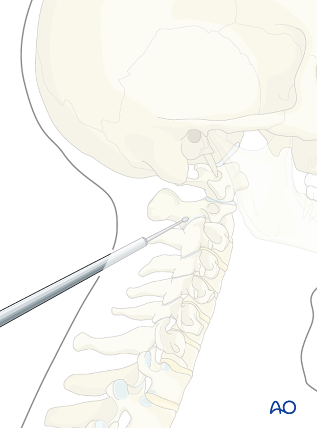 trans articular screw insertion