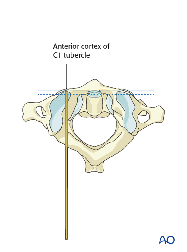trans articular screw insertion