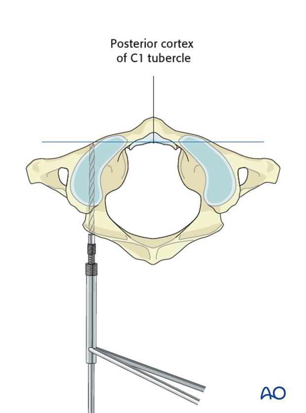 The tip of the drill should not advance further than the posterior cortex of the C1 tubercle during lateral mass screw insertion