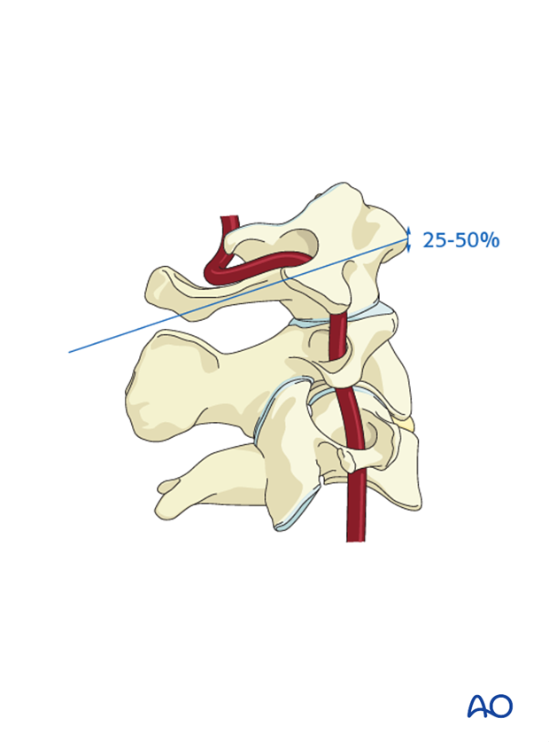 In the craniocaudal direction, the drill should aim at the bottom 25-50% of the C1 tubercle during lateral mass screw insertion