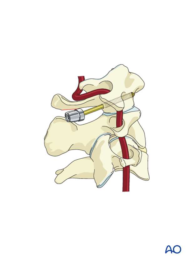 Inserting a C1 lateral mass screw