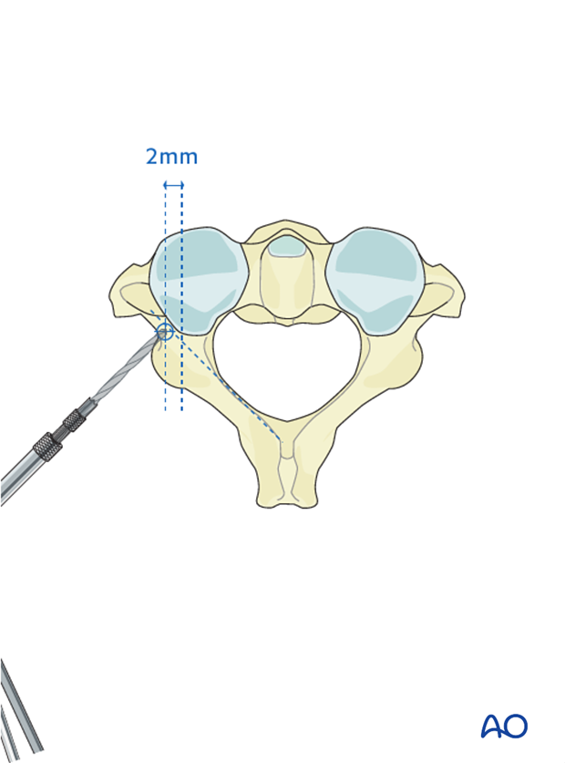 c2 pedicle screw insertion