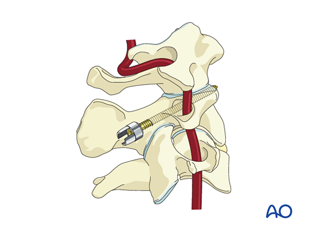 C2 pedicle screw insertion
