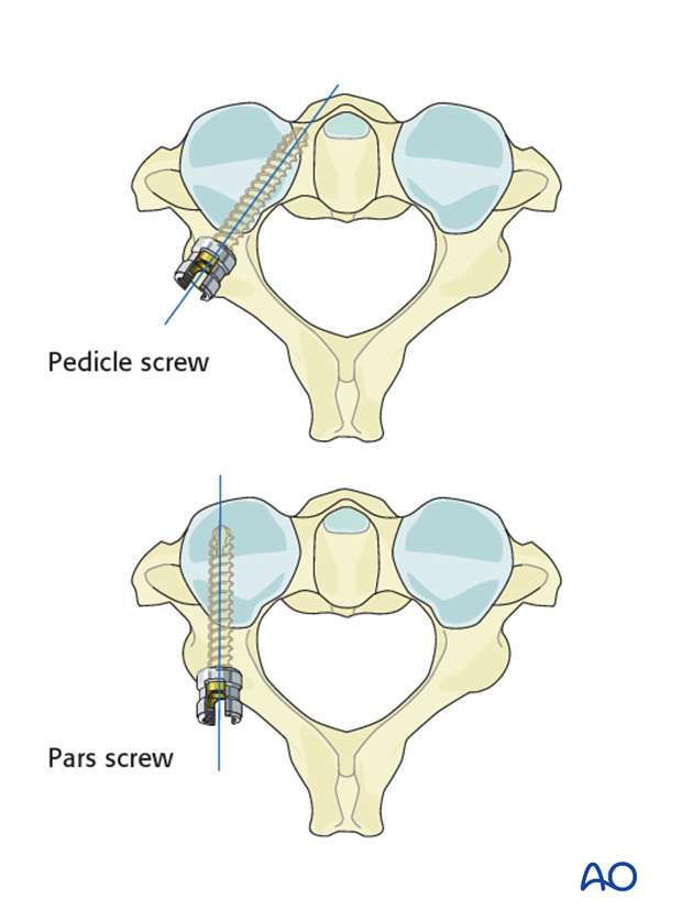 C2 pedicle vs. pars screw 
