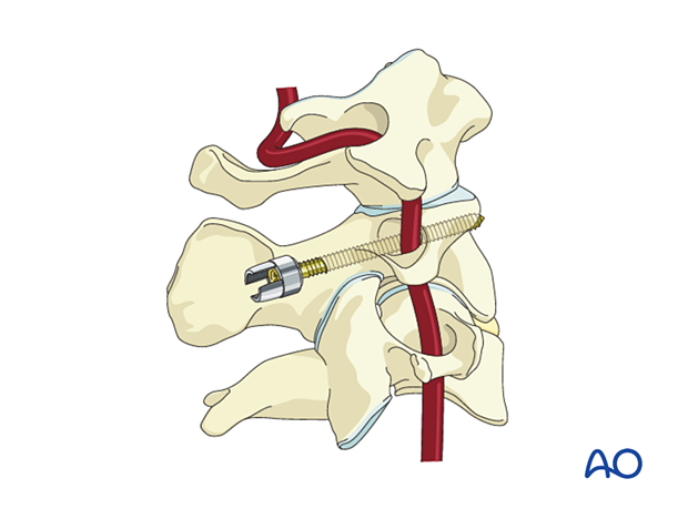 c2 pedicle screw insertion