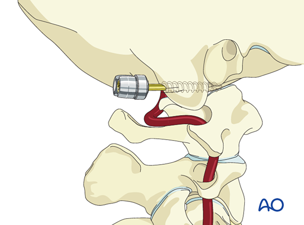 occiput condyle screw insertion
