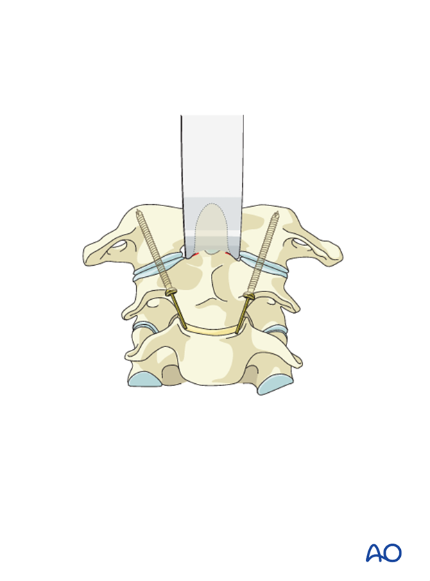 anterior c1 c2 trans articular screws