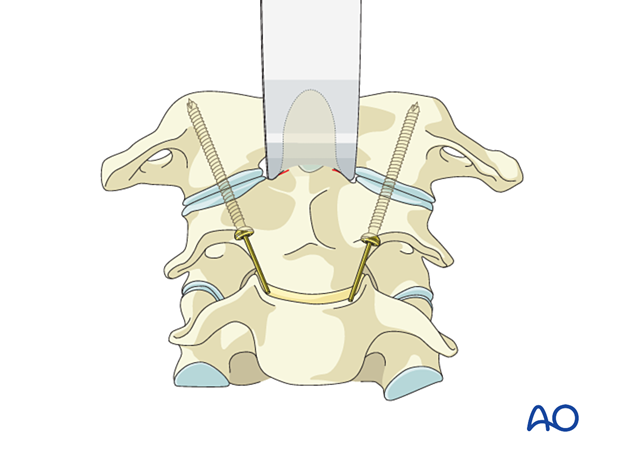Anterior C1–C2 transarticular screw