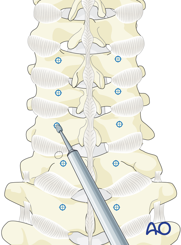 Opening the cortex during lateral mass screw insertion magerl technique