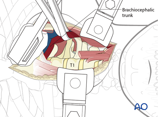 anterior approach to the cervico thoracic junction