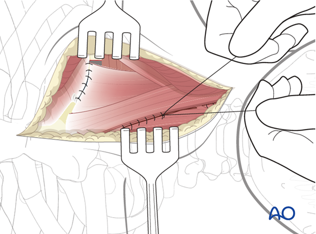 anterior approach to the cervico thoracic junction