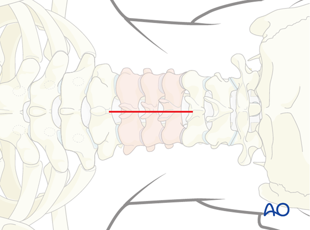 posterior approach to the cervical spine