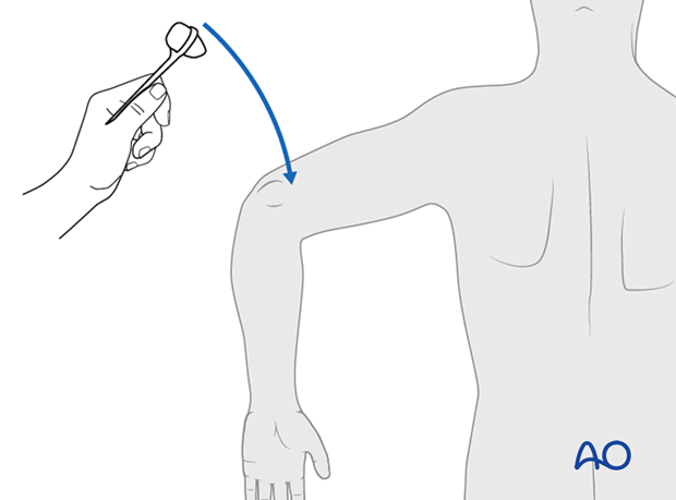 Examination of triceps tendon reflex (C7)