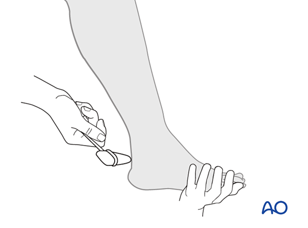 Reflex examination of Achilles tendon (S1)