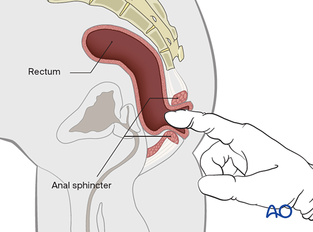 Rectal examination performed to assess for anal sphincter tone as well as proprioception and perianal sensation