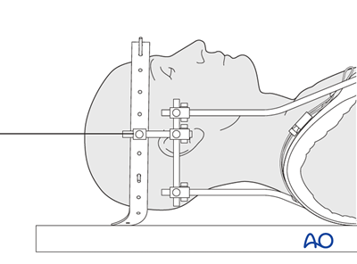 Nonoperative (halo vest) for A3 Burst fracture of single endplate